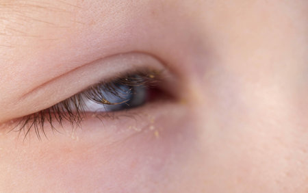 Red eye of a girl during a viral cold. Inflammation conjunctivitisの写真素材