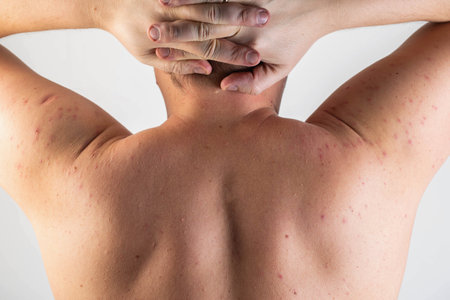 Red spots and rashes on the skin of the back and shoulders after drinking alcohol. Anaphylactic shock, alcohol intolerance. Alcoholic urticaria and atopic dermatitis.の写真素材