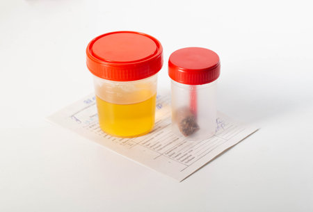 Urine and feces analysis on a medical direction on the table. Concept of tests in urology and gastroenterology.の写真素材