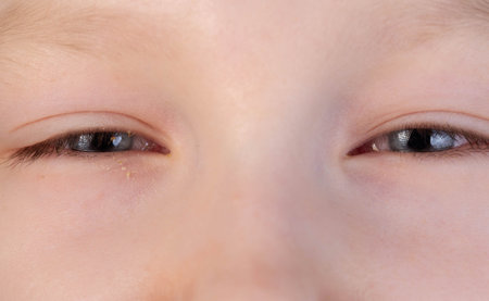 The girl has swollen, reddened, painful eyes. Inflammation of conjunctivitis, pus in the eyes. Bacterial infectionの写真素材