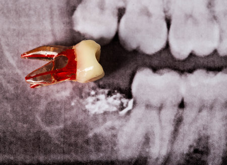 artificial wisdom tooth against the background of an extracted wisdom tooth in an x-ray imageの写真素材
