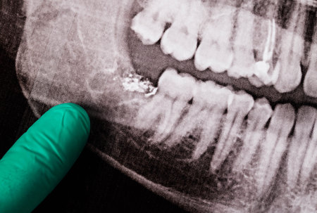 A doctor's finger in a green medical glove pointing to an x-ray with a lower wisdom tooth removedの写真素材