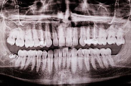 X-ray of the dental jaw with removed lower wisdom teethの写真素材