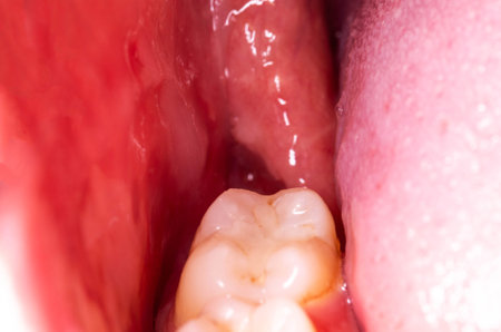 recess after complex impacted wisdom tooth extraction, traumatic healing. Dry socket, alveolitis. Space for textの写真素材