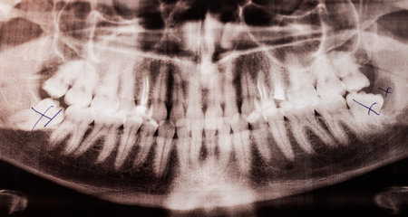Dental jaw with crossed out Russian wisdom teeth and a purulent cyst on an x-ray image