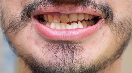 Crooked teeth in a man with a patchy beard