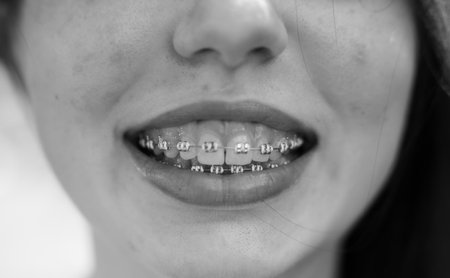 Monochrome close-up of a smiling person's mouth with dental braces.の写真素材