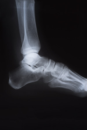 Medical X ray image of footの写真素材