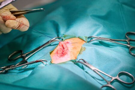 Operation process on a patient. Surgeon's hands in protective gloves doing surgery with medical tools .の写真素材