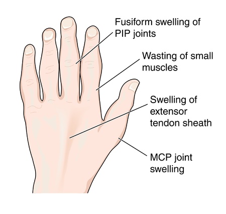 Changes in the hand due to arthritisのイラスト素材