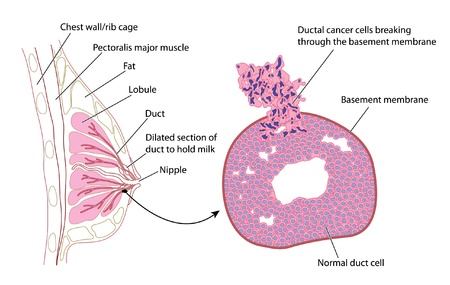Cross section of breast with detail of ductal carcinomaのイラスト素材