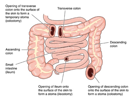 Sites of colostomies in the transverse and descending colon, and the site of an ileostomyのイラスト素材