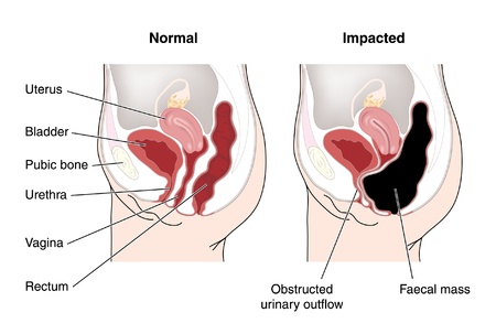 Drawing of a normal and impacted bowel containing compressed impacted fecal matterのイラスト素材