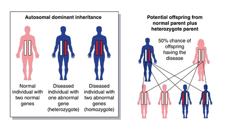 Diagram to show the potential offspring from a parent with two normal genes and a heterozygous parent with one dominant abnormal geneのイラスト素材