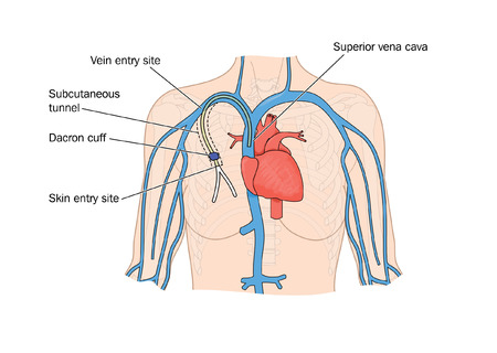 Drawing of PICC catheter insertion into heartのイラスト素材