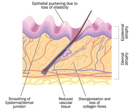 Old skin, showing changes due to aging, including epithelial puckering and reduced collagen and vascular tissue. Created in Adobe Illustrator.  Contains transparencies.  EPS 10.のイラスト素材