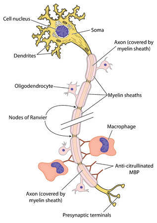 Myelinated nerve in multiple sclerosis, showing action of antibodies to myelin basic protein and macrophage action. Created in Adobe Illustrator. EPS 10.の素材 [FY31044253552]