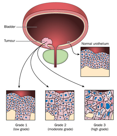 Tumour of the bladder wall, showing normal urothelial cells compared to cells from 3 stages of bladder cancer. Created in Adobe Illustrator.  Contains gradient fills. EPS 10.のイラスト素材