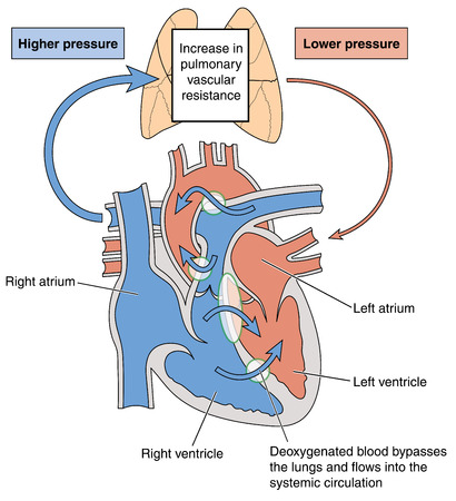 Congenital heart defects resulting in abnormal blood flow through the heart and to the lungs, resulting in Eisenmengers syndrome. Created in Adobe Illustrator.  Contains transparent objects. のイラスト素材