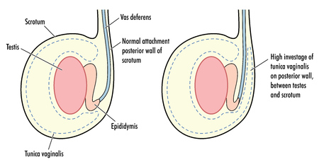 Testicle with high tunica vaginalis, a predisposing factor in testicular torsion. のイラスト素材