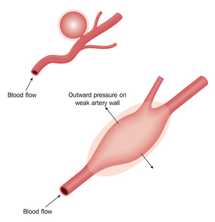 Berry aneurysm and generalized aneurysm in arterial wall.のイラスト素材