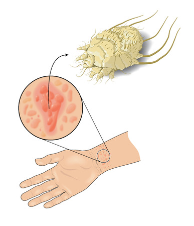 Pimple-like rash on skin caused by scabies infectionの写真素材