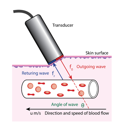 Diagram of Doppler blood flow measurement, showing the transducer on the surface of the skin.のイラスト素材