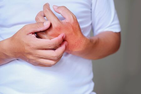 Health care concept. Itching of skin diseases in men using the hand-scratching. Red around the...