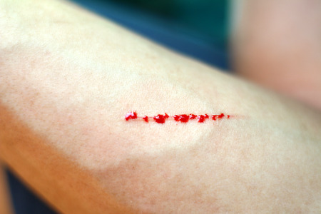 scratch fresh woundsの写真素材