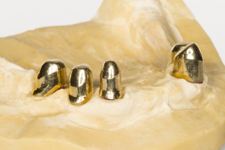 implantの写真素材