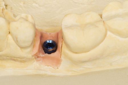 implant