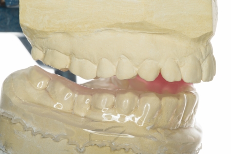 bite splint