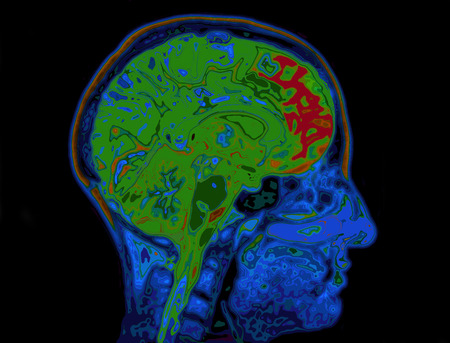 MRI Image Of Head Showing Brain