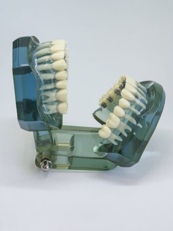 Human jaw or teeth orthodontic dental model with implants dental braces .Dental and orthodontic...