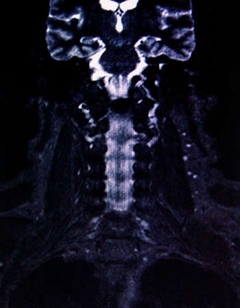 neck and the spinal columnの写真素材