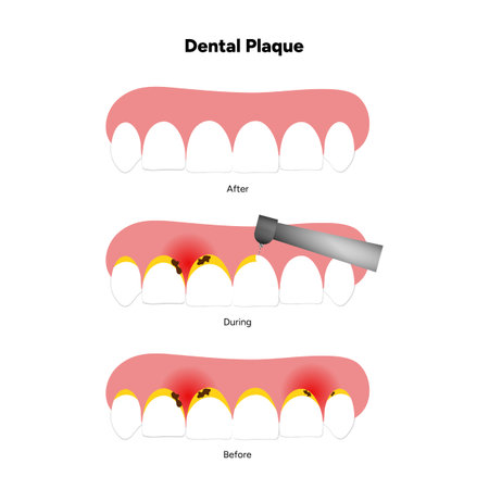 Hand-drawn dental infographic illustrating the formation of dental plaque on tooth anatomy. Includes enamel, dentin, pulp, gum line, and bacterial buildup areaのイラスト素材