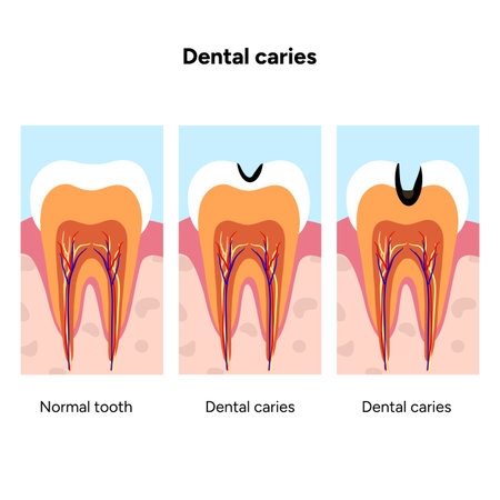 Hand-drawn dental infographic illustrating tooth anatomy and stages of cavity development. Educational medical illustration showing enamel, dentin, pulp, plaque, and decay progressのイラスト素材