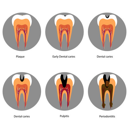 Hand-drawn dental infographic illustrating tooth anatomy and stages of cavity development. Educational medical illustration showing enamel, dentin, pulp, plaque, and decay progressのイラスト素材