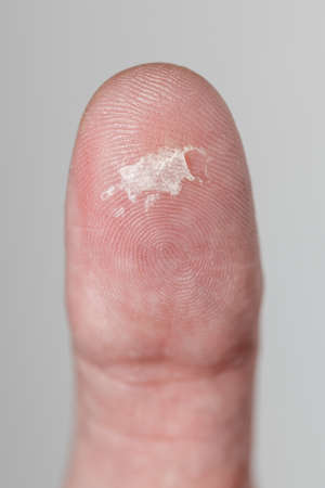 Blister on the thumb of a caucasian, close-up. Mechanical damage to the skin on the thumb of a man....
