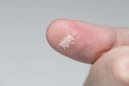 Callus on the thumb of a man. Mechanical damage to the skin. Blister on a mans hand. Problems of dermatology. Selected focusの写真素材