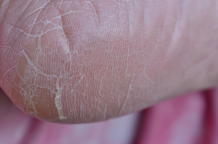 close up dry heel cracks