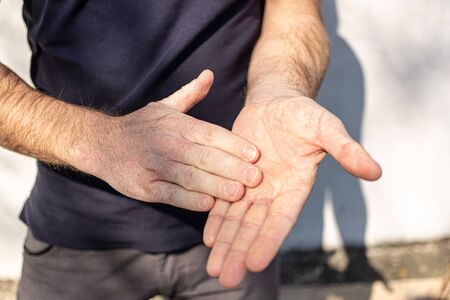 Very dry hands touching, peel due to washing alcohol on Covid19 situation. Horizontal close up of...