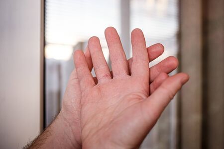 Very dry hands touching, peel due to washing alcohol on Covid19 situation. Horizontal close up of...