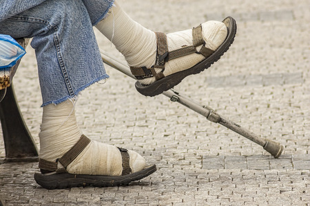 Wounded injured or crippled legs of a poor man sitting on a bench with a stickの写真素材