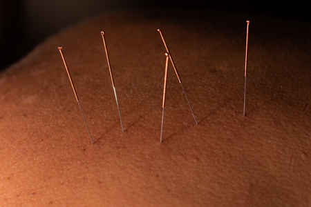 Several acupuncture needles to make treatment. Traditional Chinese medicine made with the insertion of needles in specific places of the body. Steel needles with copper head. Millenary medicine.の写真素材