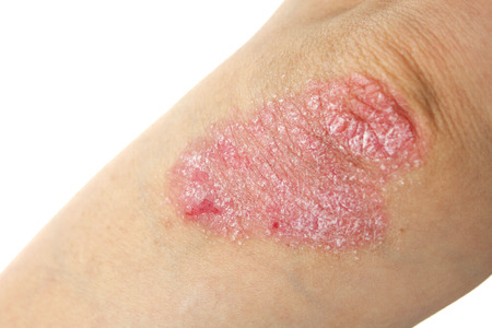 Psoriasis on elbows  Isolated on white