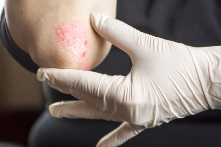 Psoriasis on elbowの写真素材