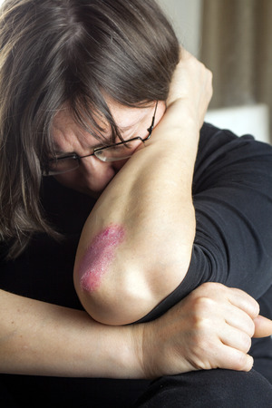 Woman with psoriasis skin Problemの写真素材