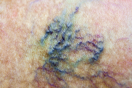 Varicose vein Macro.の写真素材