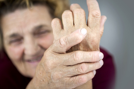 Hands Of Woman Deformed From Rheumatoid Arthritisの写真素材